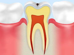 CO：初期段階の虫歯