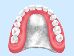 金属床義歯（チタン床）