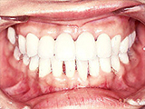 歯周病によって悪化した歯並びの審美治療