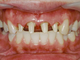 残根状態の歯の修復
