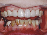 神経の処置後、長期間を経て変色した歯の治療
